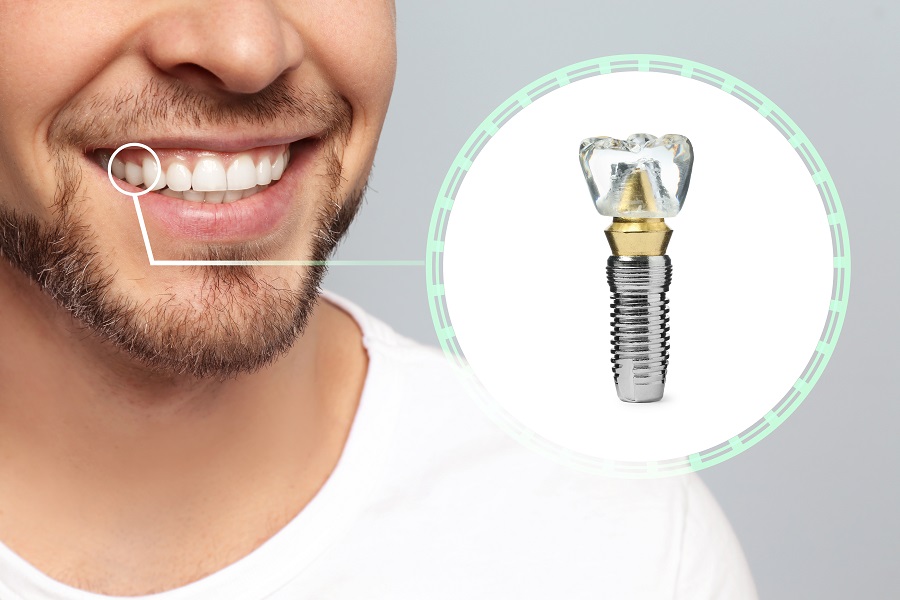 Dental Implants Are the Best Solution for Missing Teeth