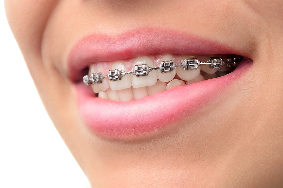 Transforming Smiles with Braces in Murrieta & Temecula, CA