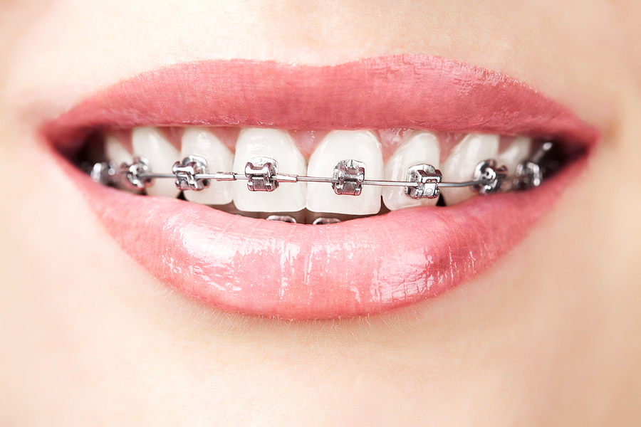 Braces 101: Everything You Need to Know Before Getting Braces