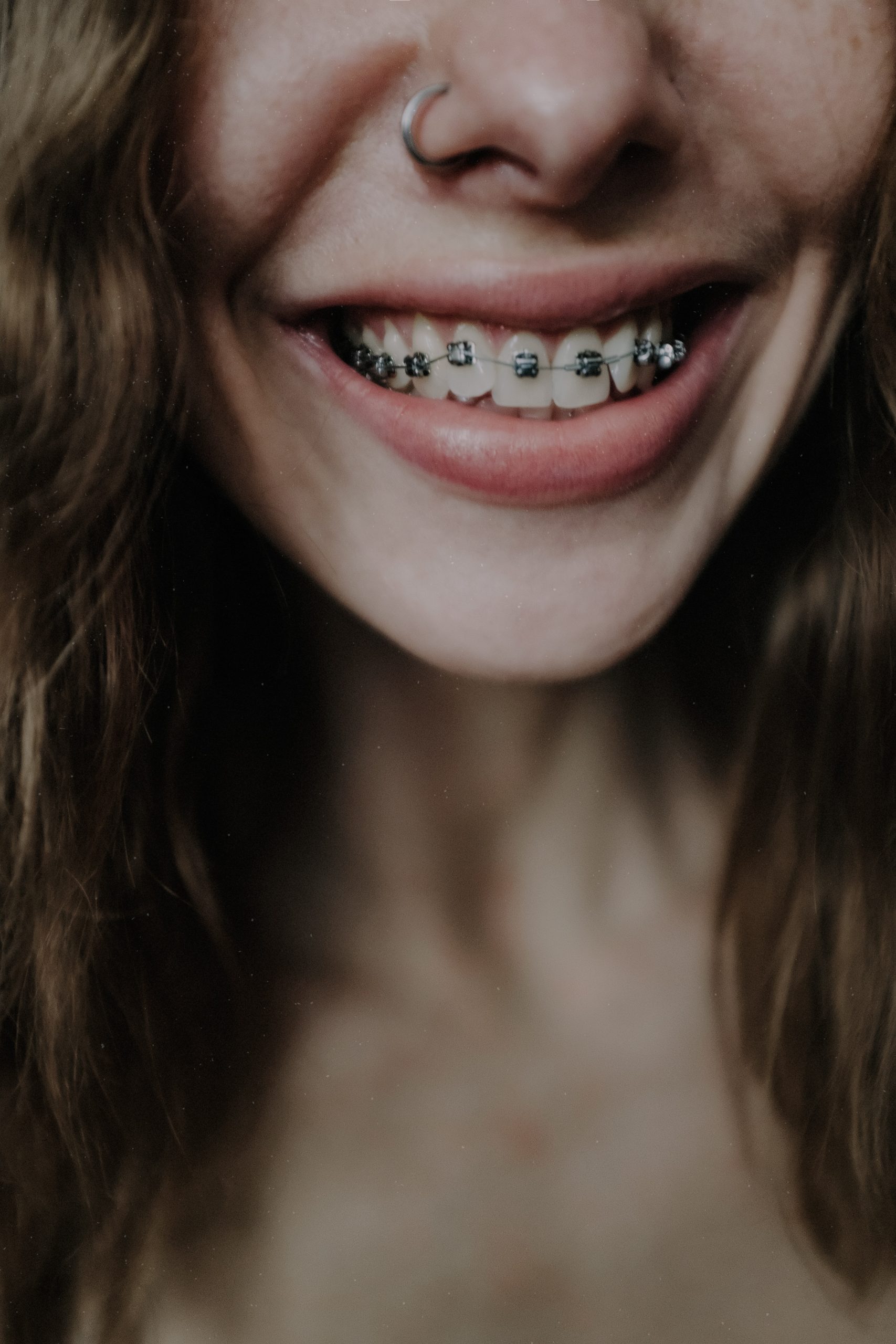 Exploring the Types of Braces in Orthodontic Treatment