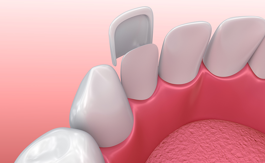 Transform Your Smile with Veneers in Murrieta & Temecula, CA