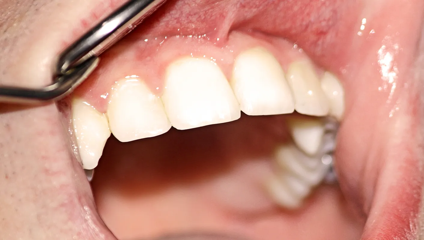 After - porcelain crown (central incisor)