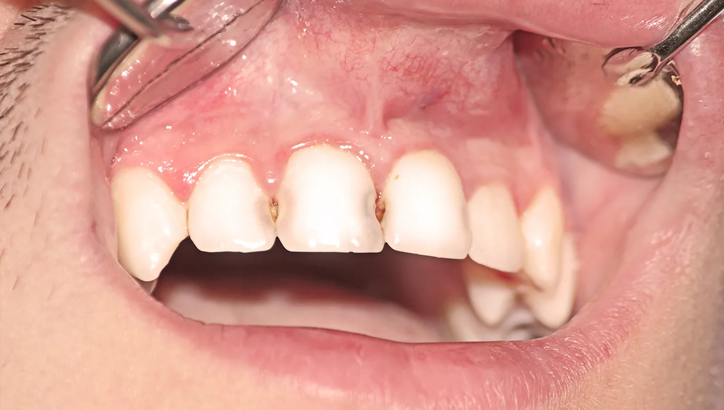 Before - poor restoration (central incisor)