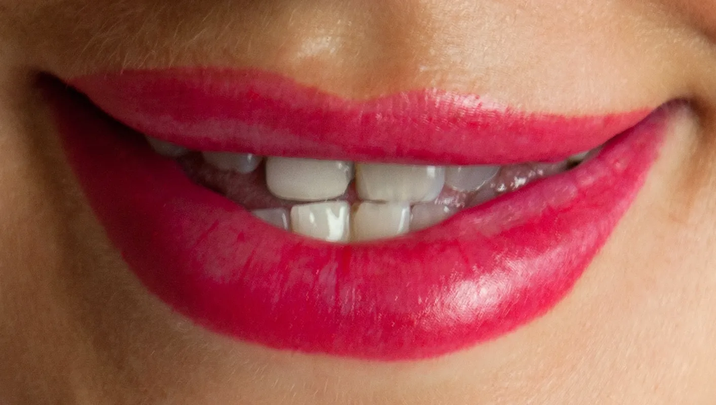 After — implant and all-porcelain crown