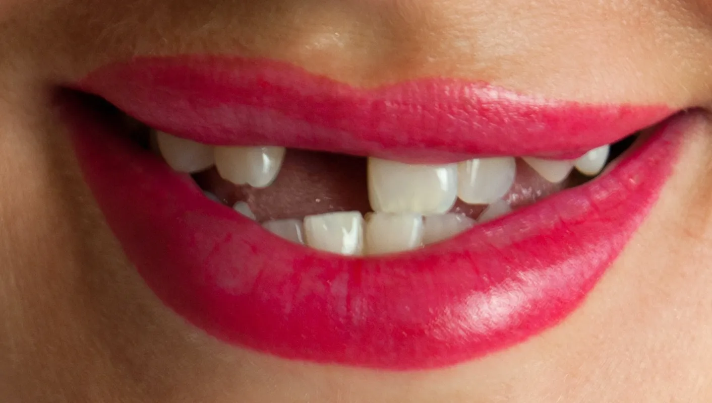 Before — single missing upper central incisor