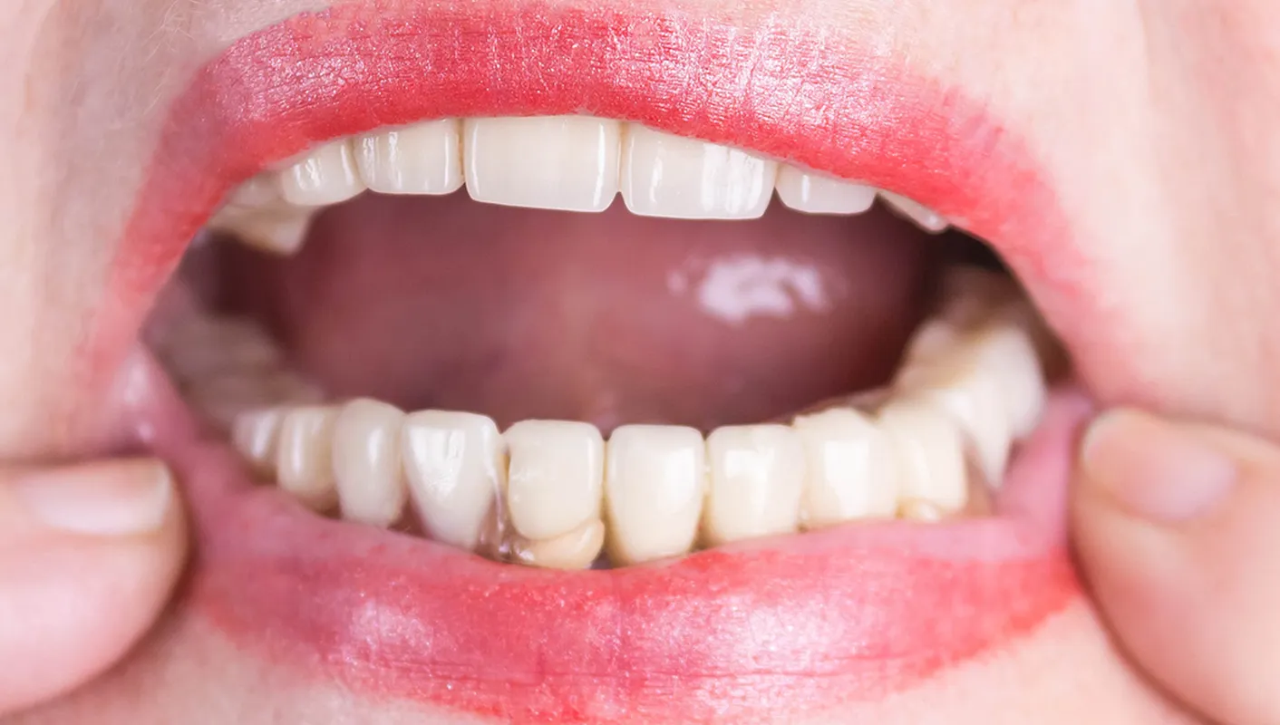 After — implant-supported dentures and crowns