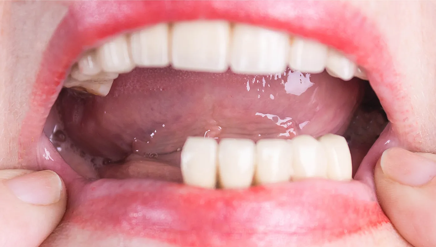 Before — upper and lower arch rehab